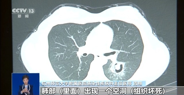 女子高烧三日竟成白肺！深度揭秘背后的真相