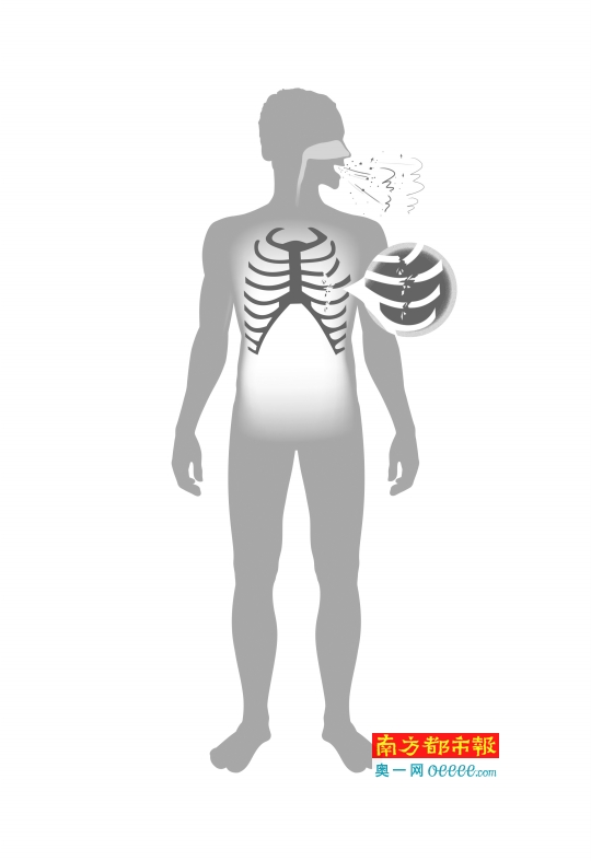 男子咳嗽咳断了肋骨